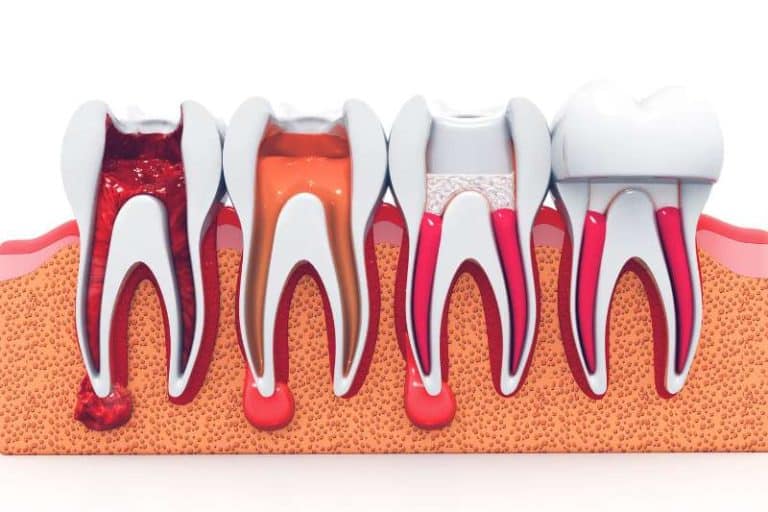 What is root canal? How Long Does a Root Canal Take? And its procedure